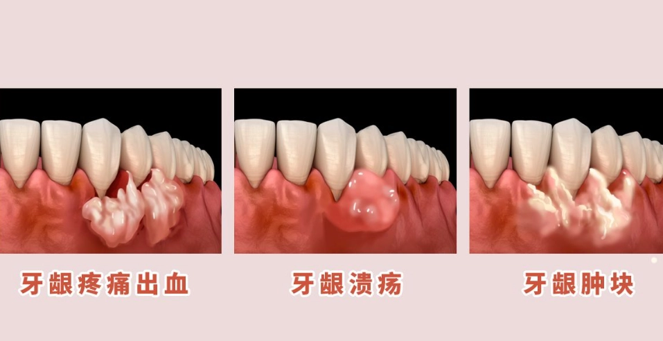 智齒發炎怎麼辦 智齒發炎怎麼辦