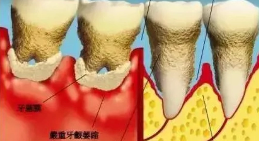 牙齦萎縮怎麼辦 牙齦萎縮怎麼辦