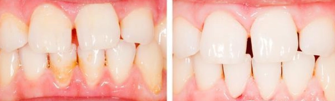 牙齦萎縮治療 牙齦萎縮治療