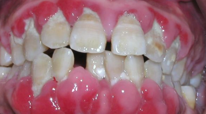 牙齦萎縮治療 牙齦萎縮治療