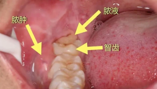 牙齦後方腫脹 牙齦後方腫脹