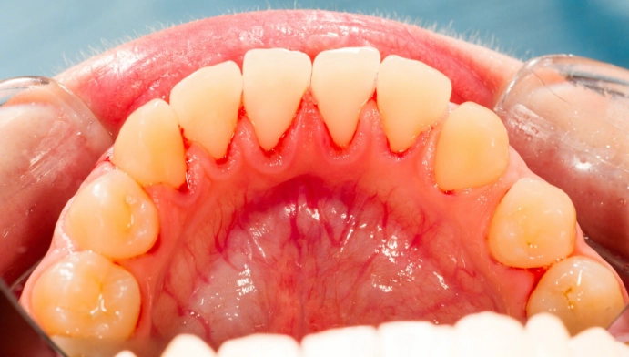 牙齦萎縮怎麼辦 牙齦萎縮怎麼辦