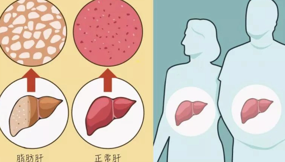 脂肪肝改善方法