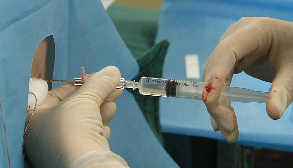 減輕麻醉針痛 減輕麻醉針痛