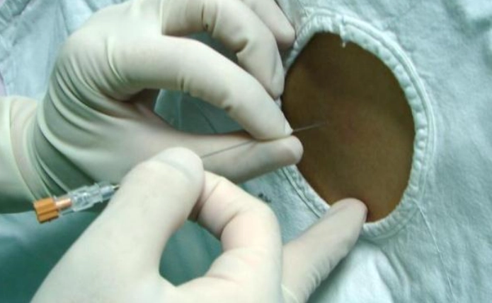 打麻醉針疼痛 打麻醉針疼痛