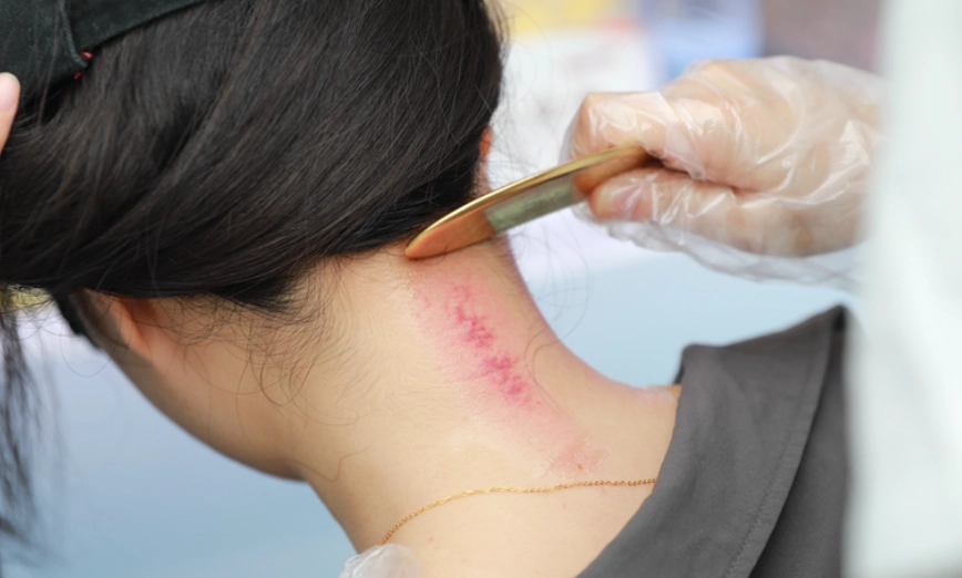 刮痧後紅印幾天會消？完整時間線與加速消退實用指南