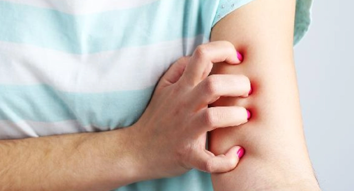 類固醇藥膏蚊子叮 類固醇藥膏蚊子叮