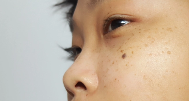 黑斑藥膏推薦 黑斑藥膏推薦