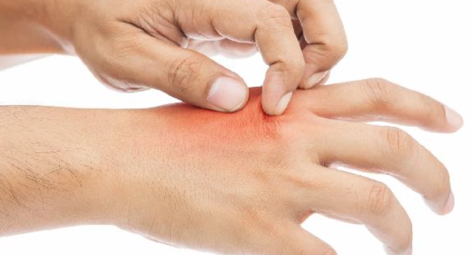 蚊蟲叮咬過敏反應