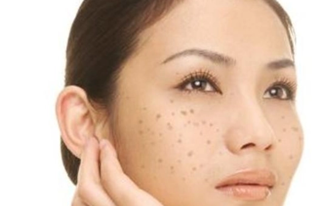 黑斑去除方法 黑斑去除方法
