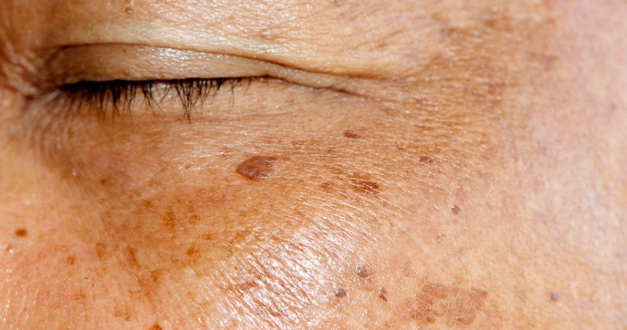 臉部黑斑處理 臉部黑斑處理