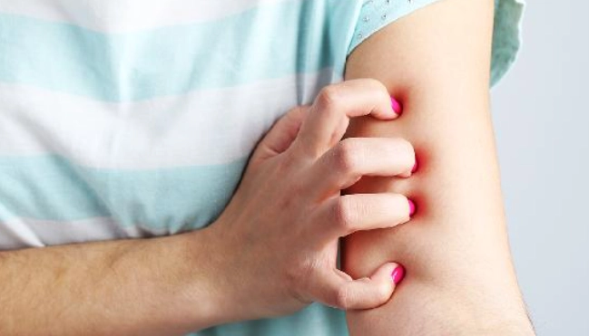 蚊子叮咬腫脹處理