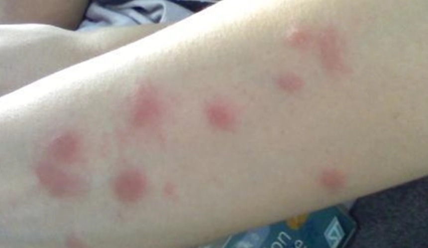 蚊子叮咬腫脹處理