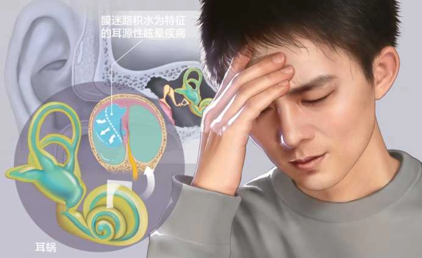 眩暈症多久會好 眩暈症多久會好