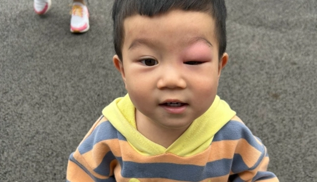 眼皮被蚊子叮快速消腫