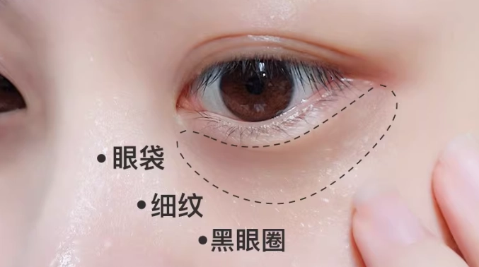 眼袋成因