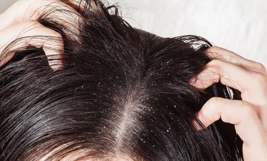 脂漏性皮膚炎治療