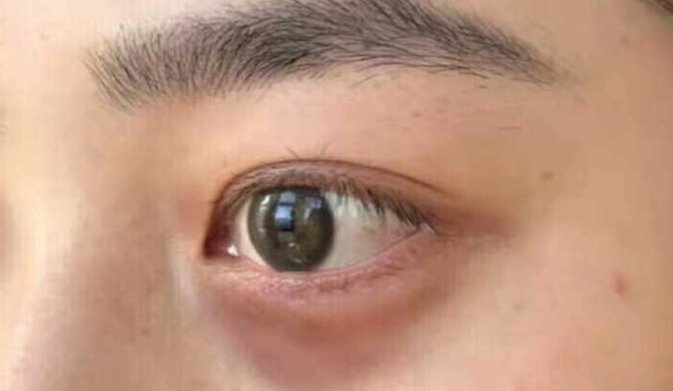 眼袋消除