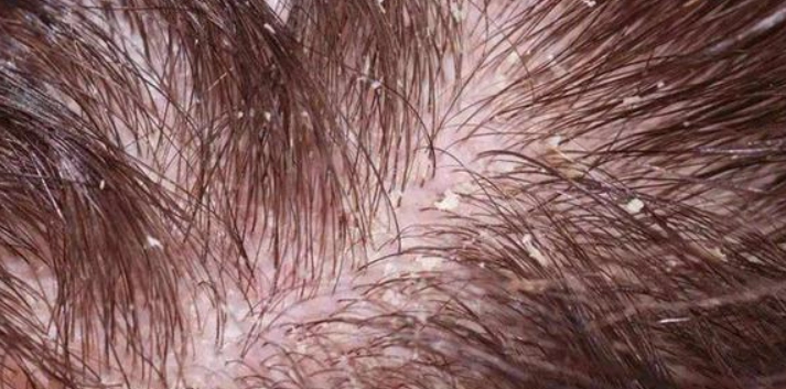 頭皮癢原因 頭皮癢原因