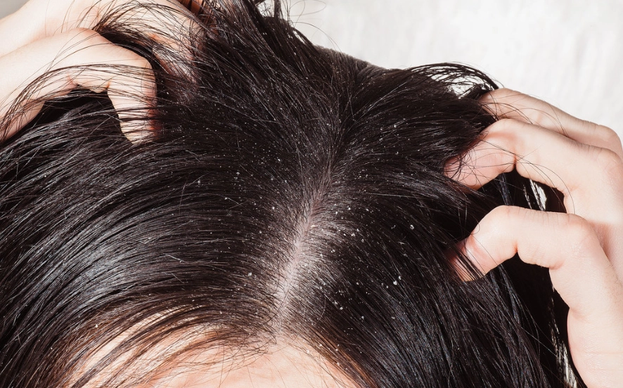 頭皮癢原因 頭皮癢原因