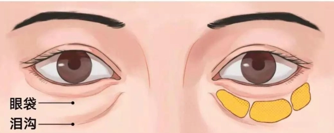 眼袋凹陷原因