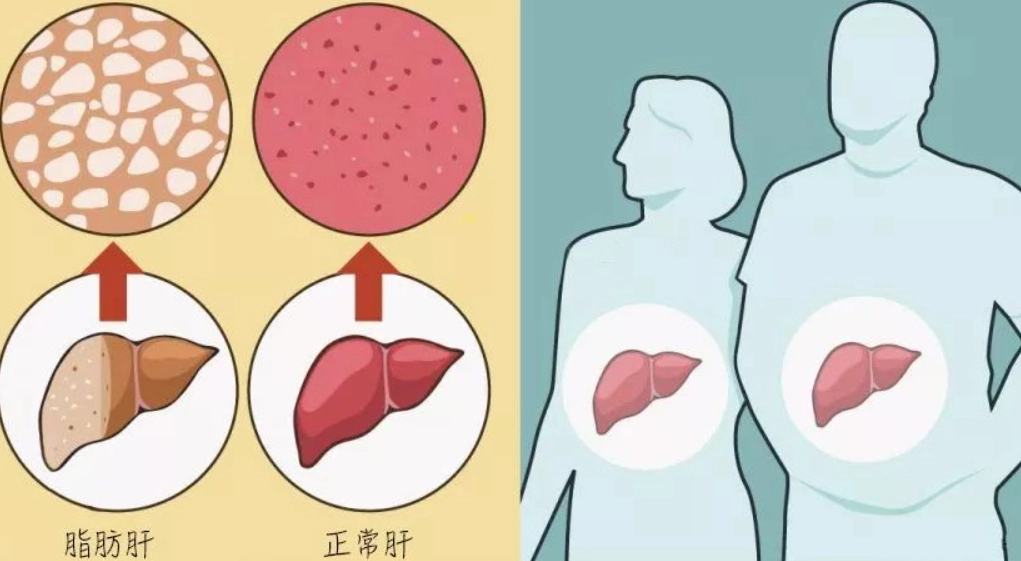 脂肪肝中藥方 脂肪肝中藥方