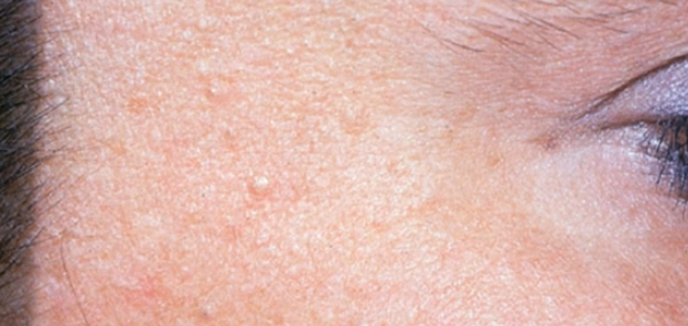 閉鎖性粉刺原因