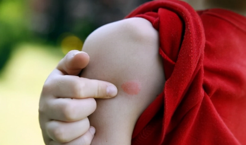 毒蚊子叮咬全攻略：症狀、預防與治療方法一次看懂