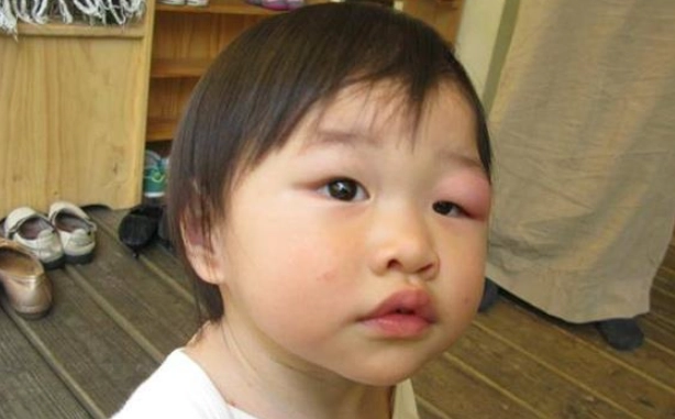 被蚊子叮眼睛怎麼消腫