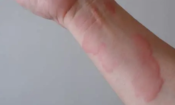蕁麻疹症狀