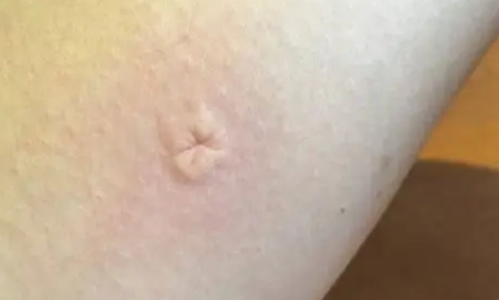 容易被蚊子叮的原因