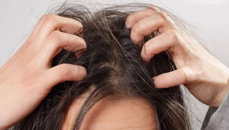 頭皮乾癢怎麼辦