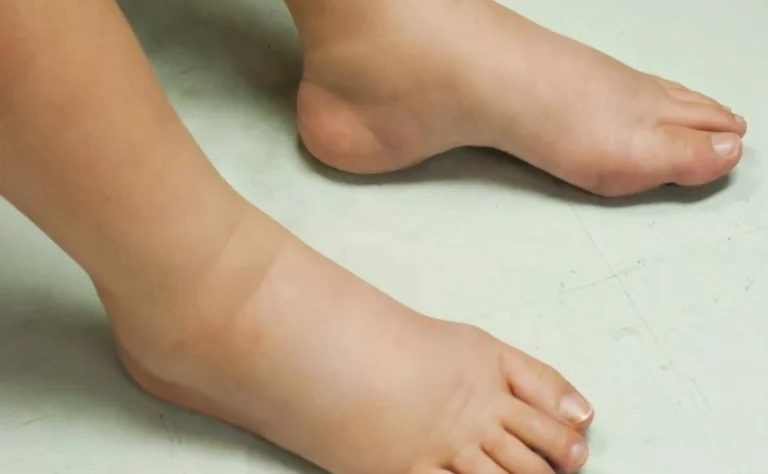 喝酒隔天會水腫嗎