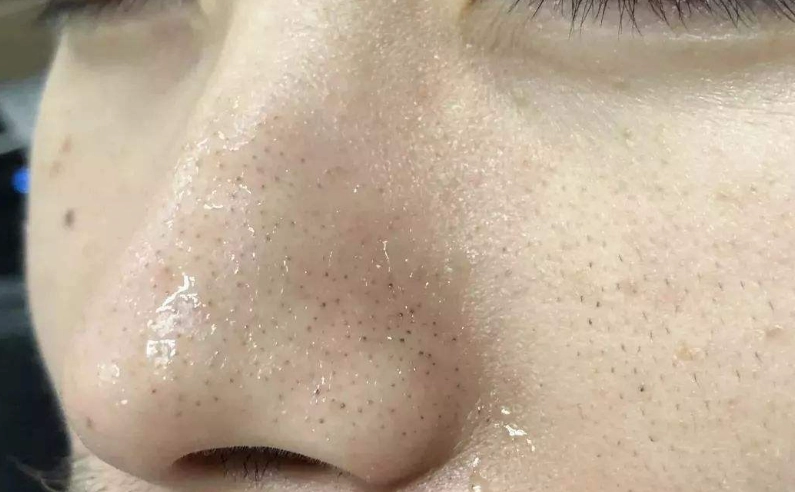 如何去除黑头粉刺：终极指南与实用技巧大全