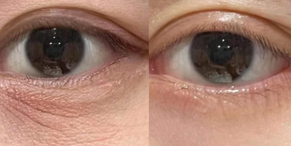 法令紋暗沉怎麼辦？徹底解析成因、保養與治療全攻略