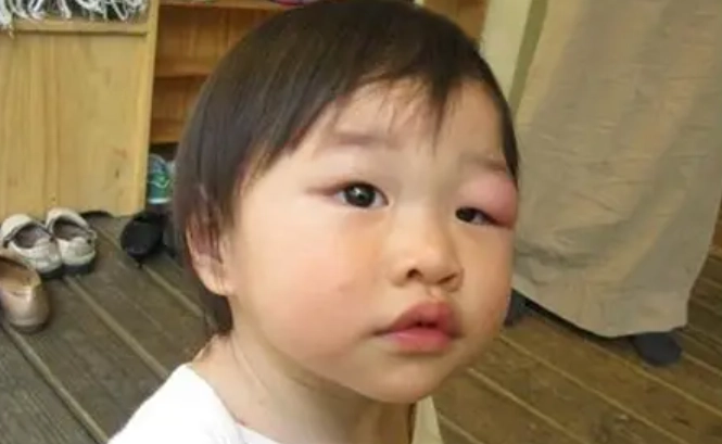 眼皮被蚊子叮多久消腫