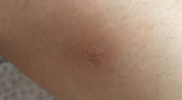 蚊子叮癢好幾天不消？完整解決瘙癢困擾的實用指南