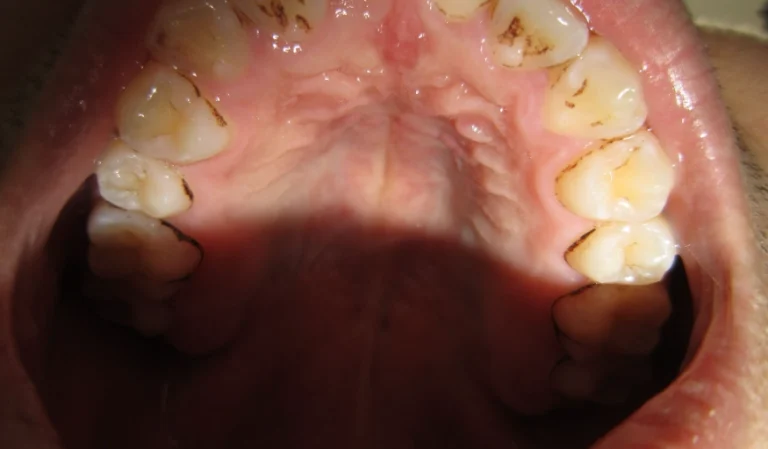 牙齒後面的肉腫起來怎麼辦