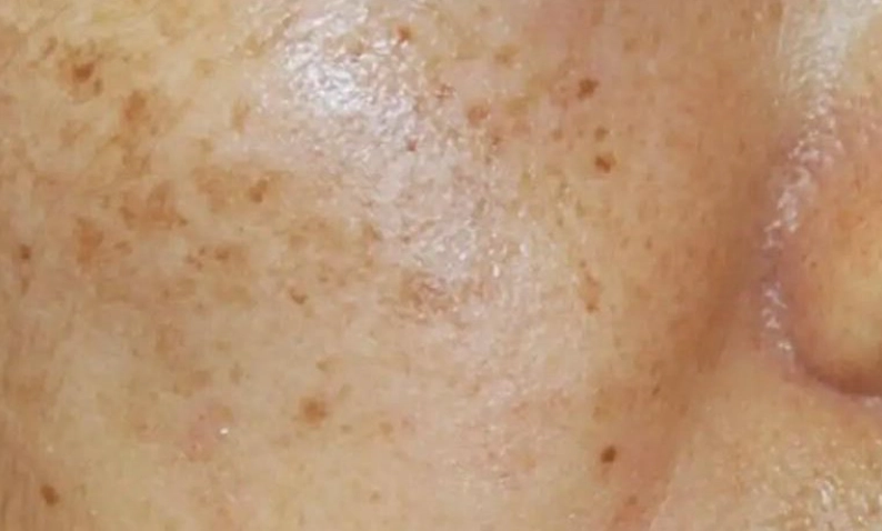 壓力斑全攻略：從成因到治療，徹底解決皮膚煩惱