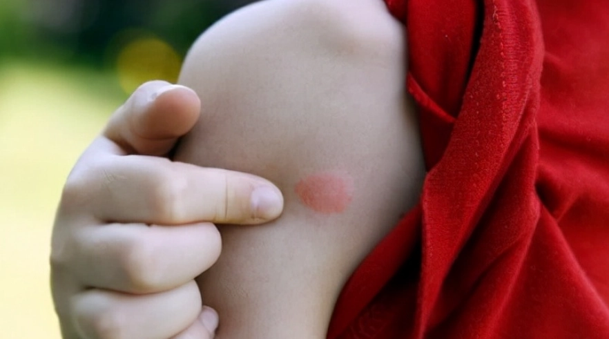 被蚊子叮腫很大原因？揭秘腫脹背後的關鍵因素與解決之道