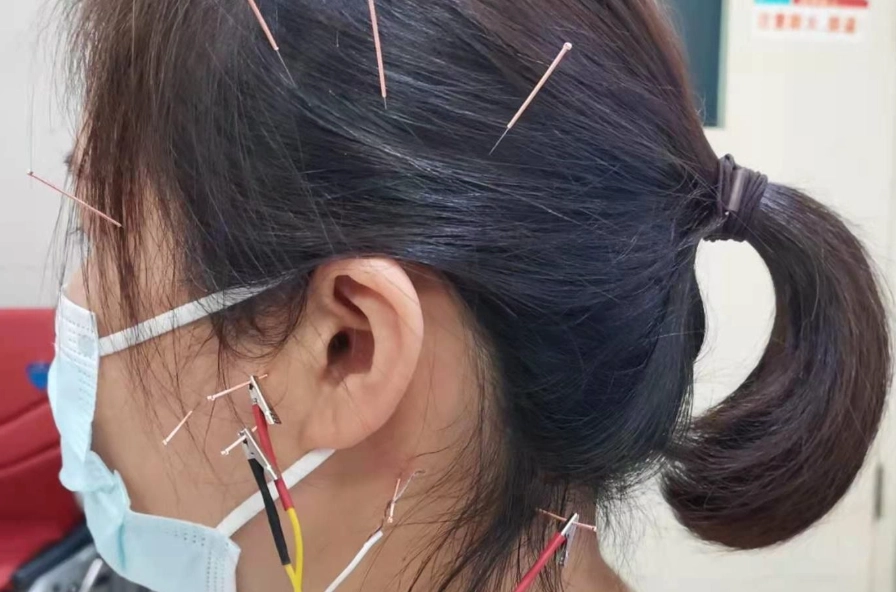 耳鳴針灸多久才能有效？治療時間與效果完整指南