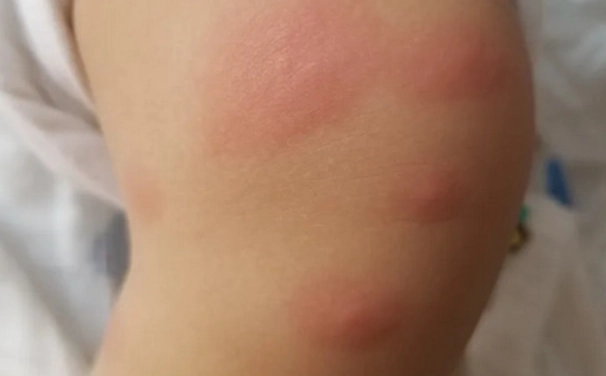 被蚊子叮腫很大怎麼辦