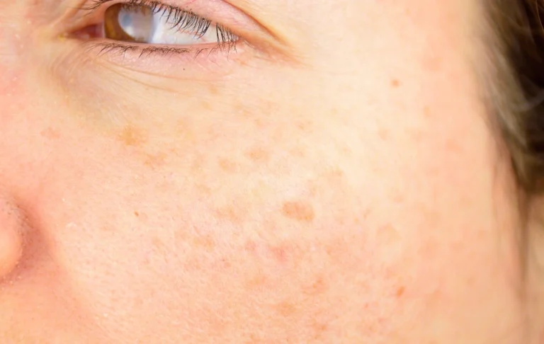 臉上的斑越來越大