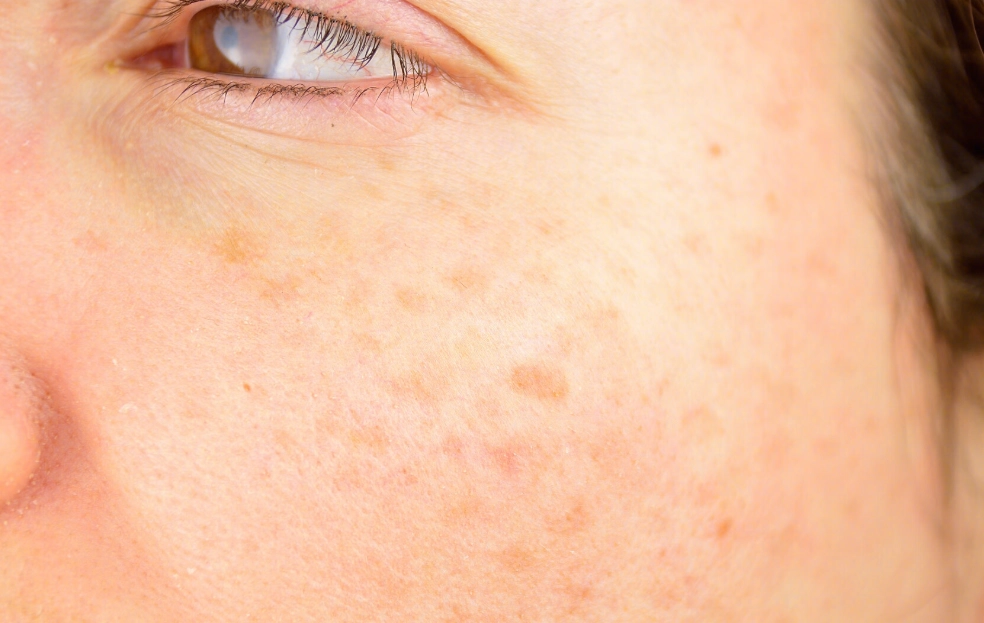 臉上斑點變大怎麼辦？專家解析原因、治療與預防全攻略