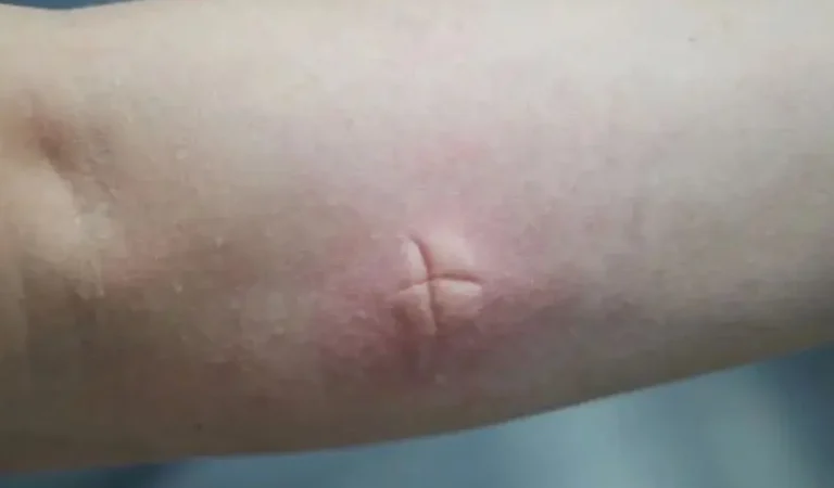 為什麼被蚊子叮會腫很大