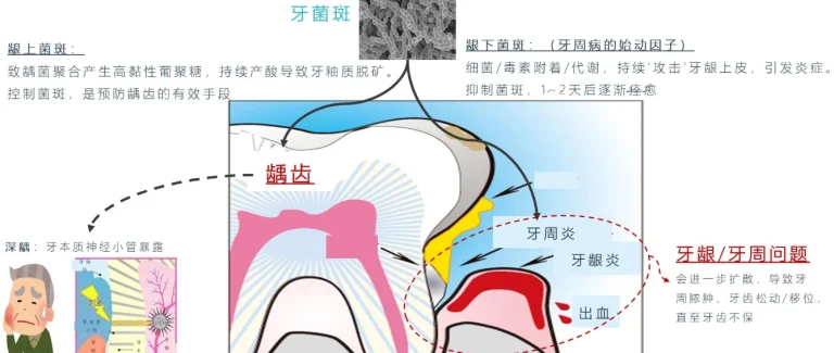牙菌膜清除