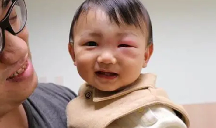 幼兒蚊子叮眼皮