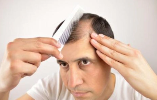 男士脫髮治療