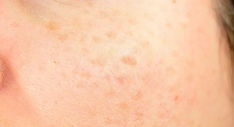 如何去斑最有效