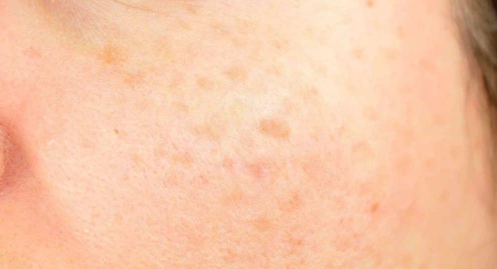 如何去斑最有效？完整指南：從成因到治療方法全解析